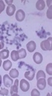 Thrombocytosis in Under-Five Children with Lower Respiratory Tract Infection